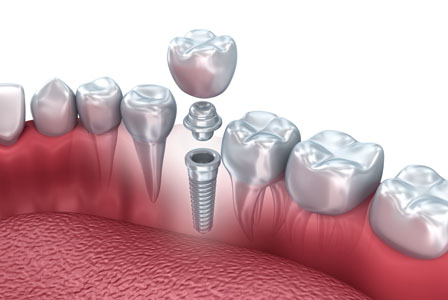 How Dental Implants Are Placed In The Jawbone