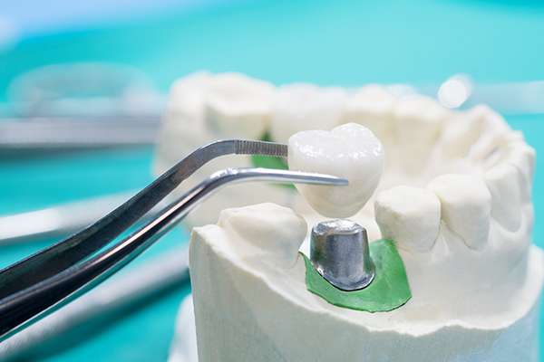 How Long Your Dental Crown Will Last